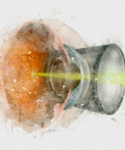 ophthalmologist gift retinal laser art print