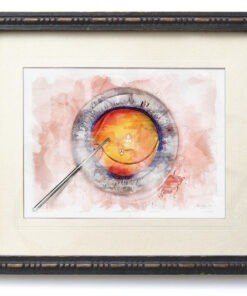 IOL Manipulation in cataract surgery framed print