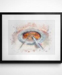 cataract surgery art print gift framed