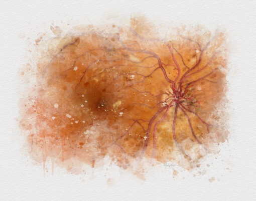 Retina doctor art print, diabetic retinopathy watercolor